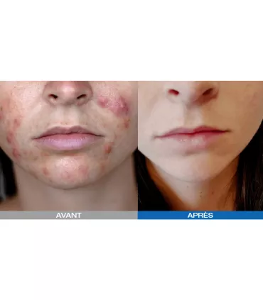 Led Photodynamique Kn7000d - Beauty Tech®