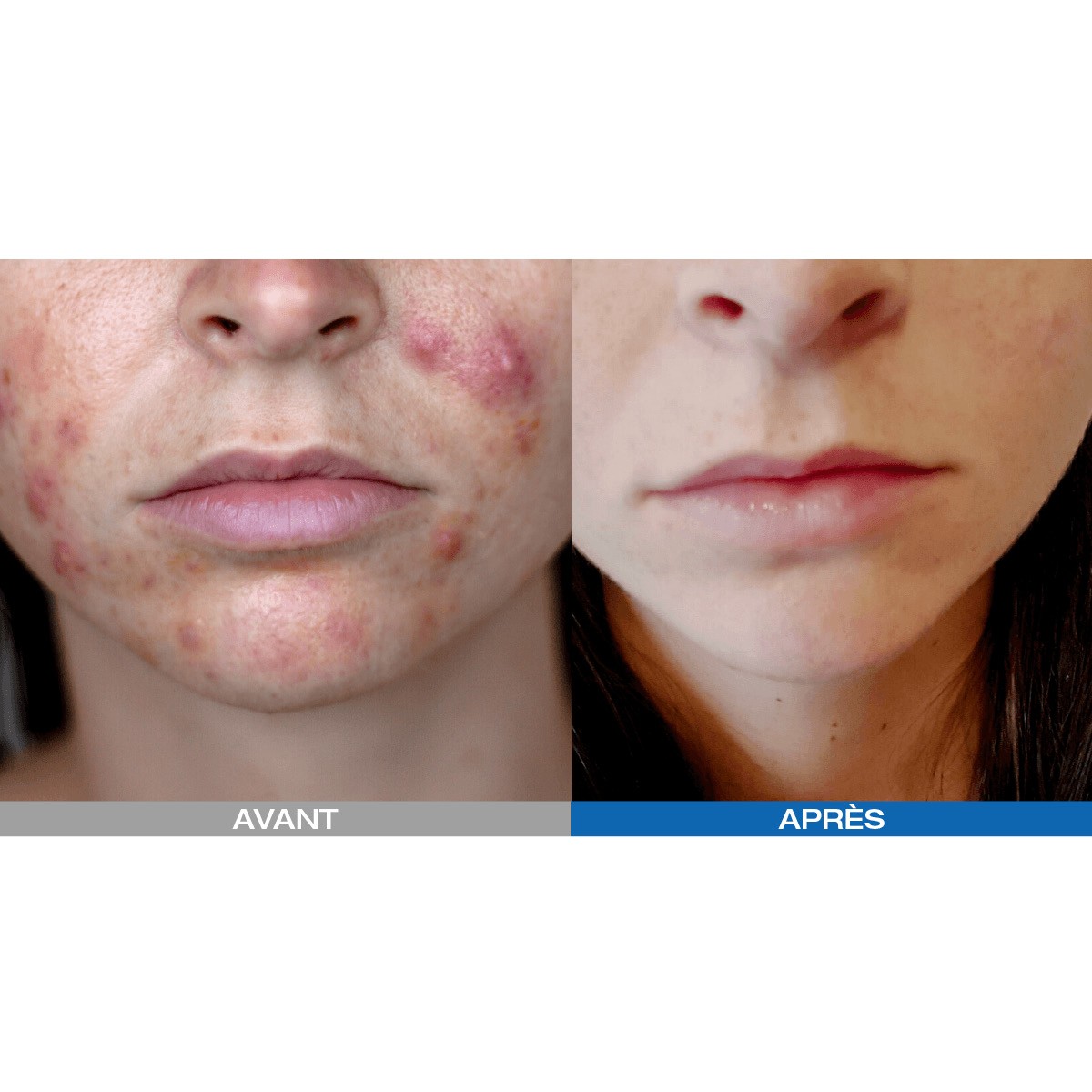 Led Photodynamique Kn7000d - Beauty Tech®