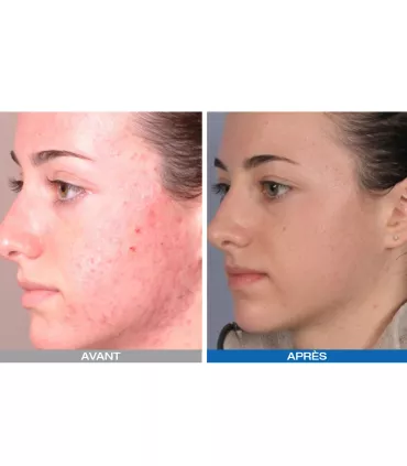 Led Photodynamique Kn7000d - Beauty Tech®