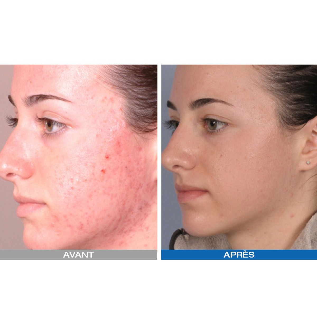 Led Photodynamique Kn7000d - Beauty Tech®