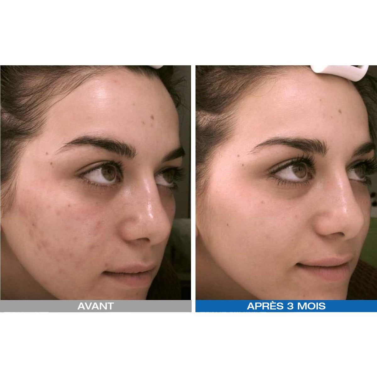 Led Photodynamique Kn7000d - Beauty Tech®