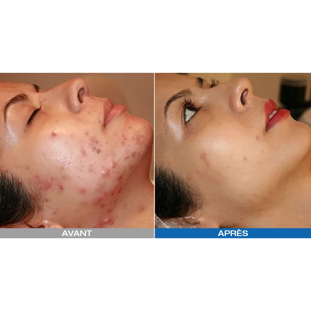 Led Photodynamique Kn7000d - Beauty Tech®