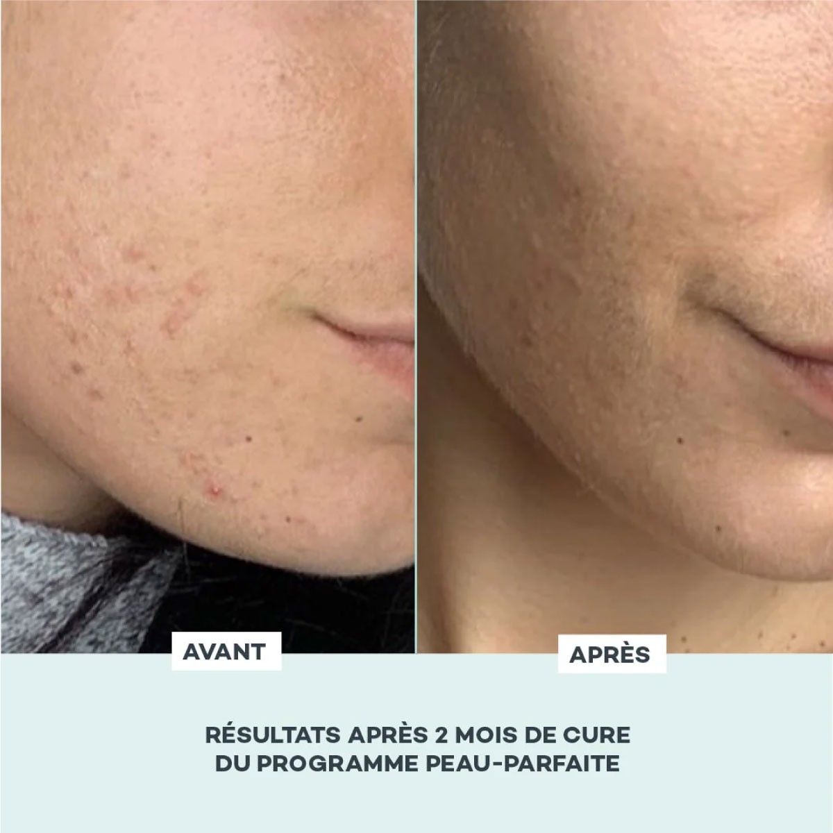 Programme Peau Parfaite • D-Lab - Beauty Tech
