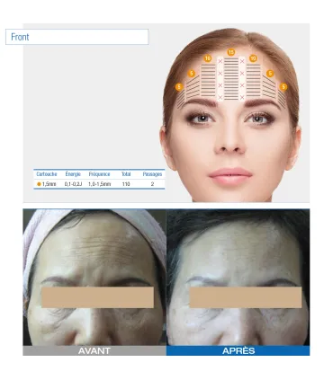 Ultraformer Iii - Occasion • Beauty Tech