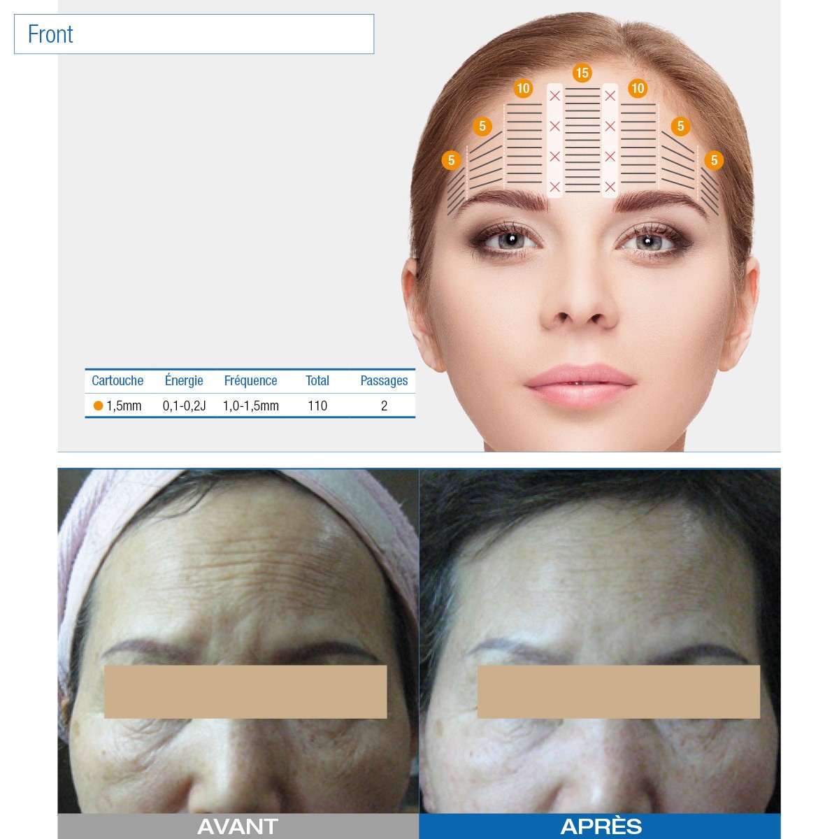 Ultraformer Iii - Occasion • Beauty Tech