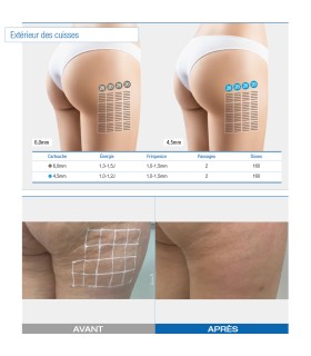 Ultraformer III - Occasion