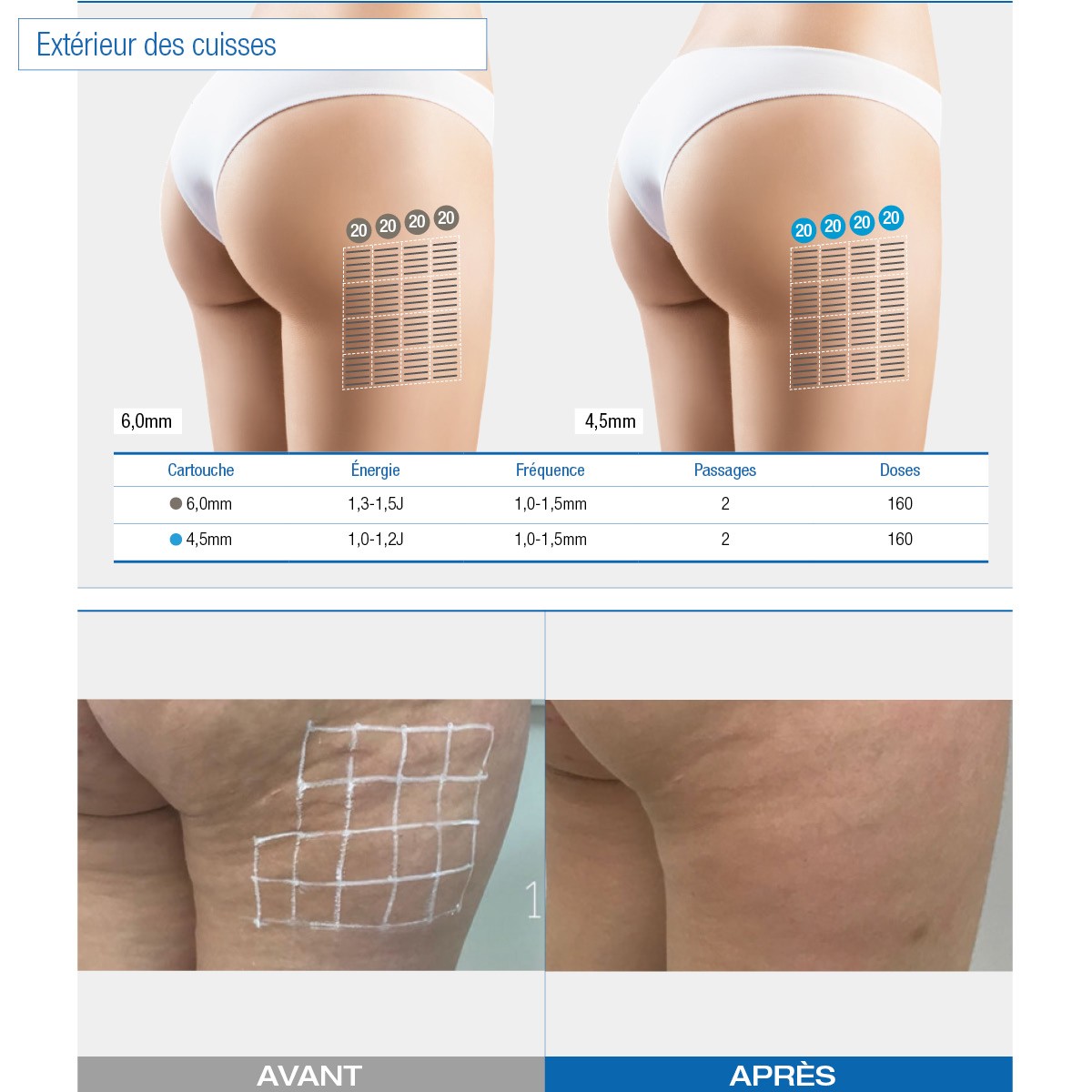 Ultraformer Iii - Occasion • Beauty Tech