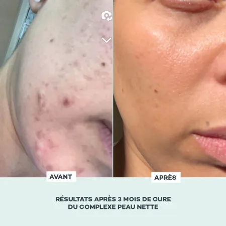 Complexe Peau Nette • D-Lab - Beauty Tech